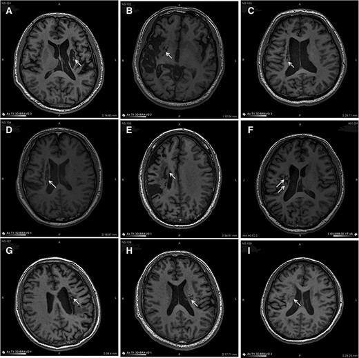 圖3:NSI-566移植后最新隨訪時梗塞部位的MRI。 圖3:NSI-566移植后最新隨訪時梗塞部位的MRI。