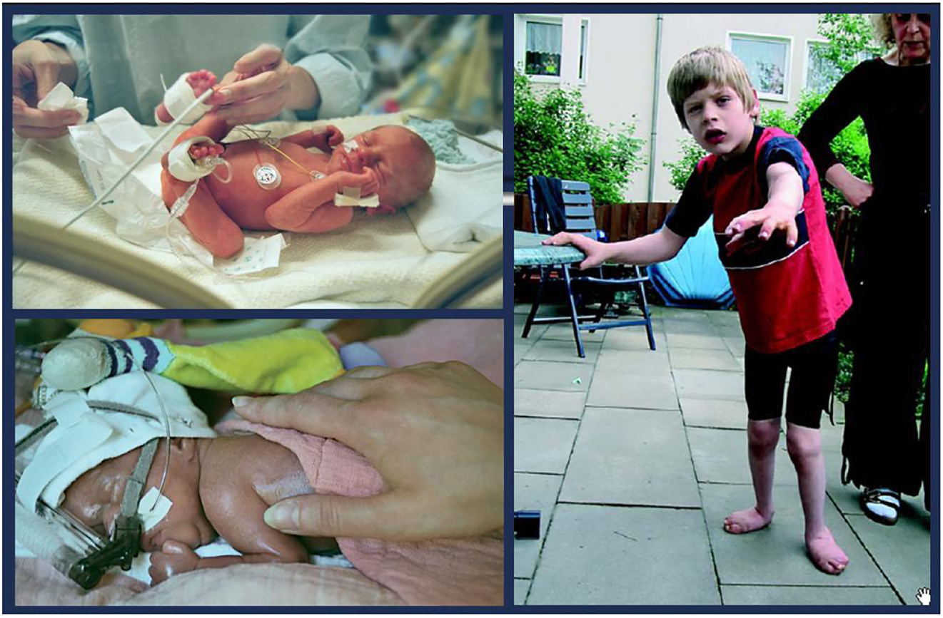 腦癱 (CP) 是兒童期最常見的殘疾,是一種嚴(yán)重的非進(jìn)行性嬰幼兒腦部疾病,具有終身后遺癥 腦癱 (CP) 是兒童期最常見的殘疾,是一種嚴(yán)重的非進(jìn)行性嬰幼兒腦部疾病,具有終身后遺癥