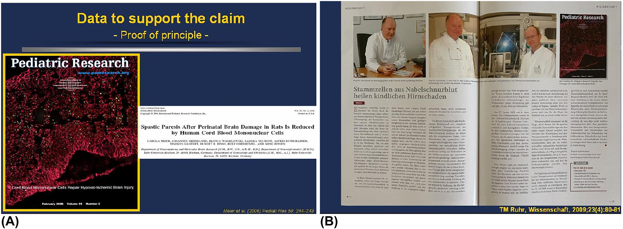 圖7:首次通過(guò)實(shí)驗(yàn)和臨床證明臍帶血MNC可潛在治愈腦性癱瘓。 圖7:首次通過(guò)實(shí)驗(yàn)和臨床證明臍帶血MNC可潛在治愈腦性癱瘓。