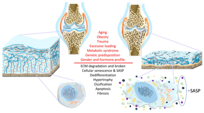 圖1:骨關節炎(OA)的風險因素、結構改變和軟骨細胞特異性變化。 圖1:骨關節炎(OA)的風險因素、結構改變和軟骨細胞特異性變化。