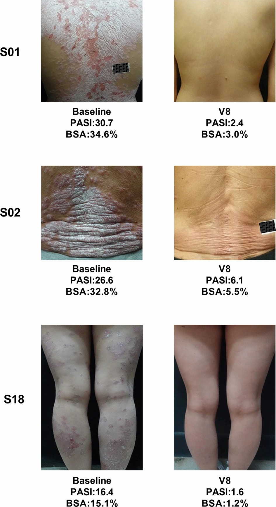 三名患者經(jīng)過治療后根據(jù) PGA 評分顯示無疾病跡象（評分為 0）或輕微疾病（評分為 1）。