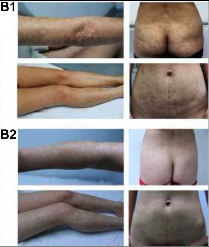 （圖B1）患者入院后體檢發(fā)現(xiàn)，患者全身遍布橙紅色斑塊，上面覆有銀色鱗屑

（圖B2）治療初期，我院給予患者3次臍帶間充質(zhì)干細(xì)胞，連續(xù)3周回輸，患者全身表面逐漸恢復(fù)光滑