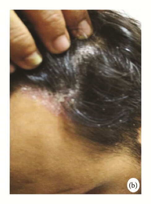骨髓間充質(zhì)干細(xì)胞 治療前，患者頭皮上出現(xiàn)大量紅斑，并附著銀色鱗片（b）。