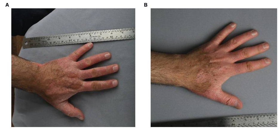 患者3細(xì)胞移植6個(gè)月后,注射部位的紅斑、脫屑和厚度明顯減少。皮膚厚度從2.1毫米減少到1.7毫米,與手部健康部位相似。該患者報(bào)告生活質(zhì)量有所提高。PASI評(píng)分在注射細(xì)胞后從4.7變?yōu)?.3。 患者3細(xì)胞移植6個(gè)月后,注射部位的紅斑、脫屑和厚度明顯減少。皮膚厚度從2.1毫米減少到1.7毫米,與手部健康部位相似。該患者報(bào)告生活質(zhì)量有所提高。PASI評(píng)分在注射細(xì)胞后從4.7變?yōu)?.3。