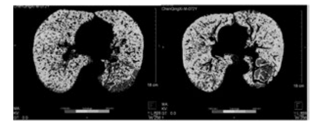 雙源CT肺實質分析軟件