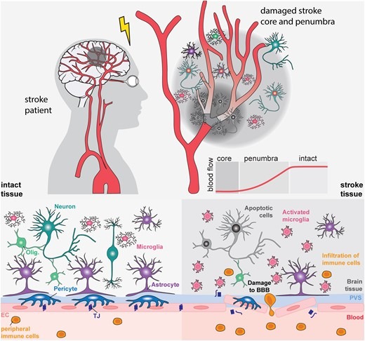 圖1:中風的病理生理學 圖1:中風的病理生理學