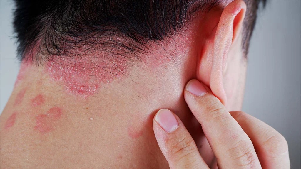 銀屑病如何治療？干細胞療法如何為銀屑病患者掃除障礙？