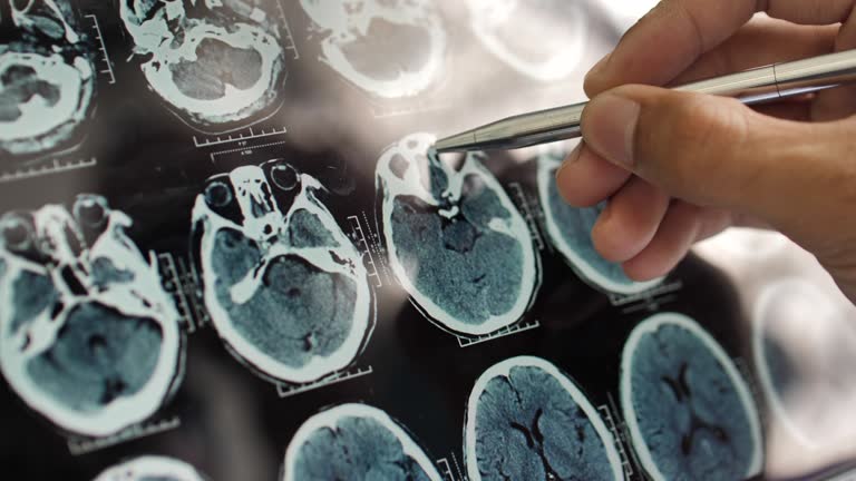 事關(guān)神經(jīng)退行性疾病,干細(xì)胞在治療神經(jīng)退行性疾病的療效、倫理、安全等問(wèn)題的綜述 事關(guān)神經(jīng)退行性疾病,干細(xì)胞在治療神經(jīng)退行性疾病的療效、倫理、安全等問(wèn)題的綜述