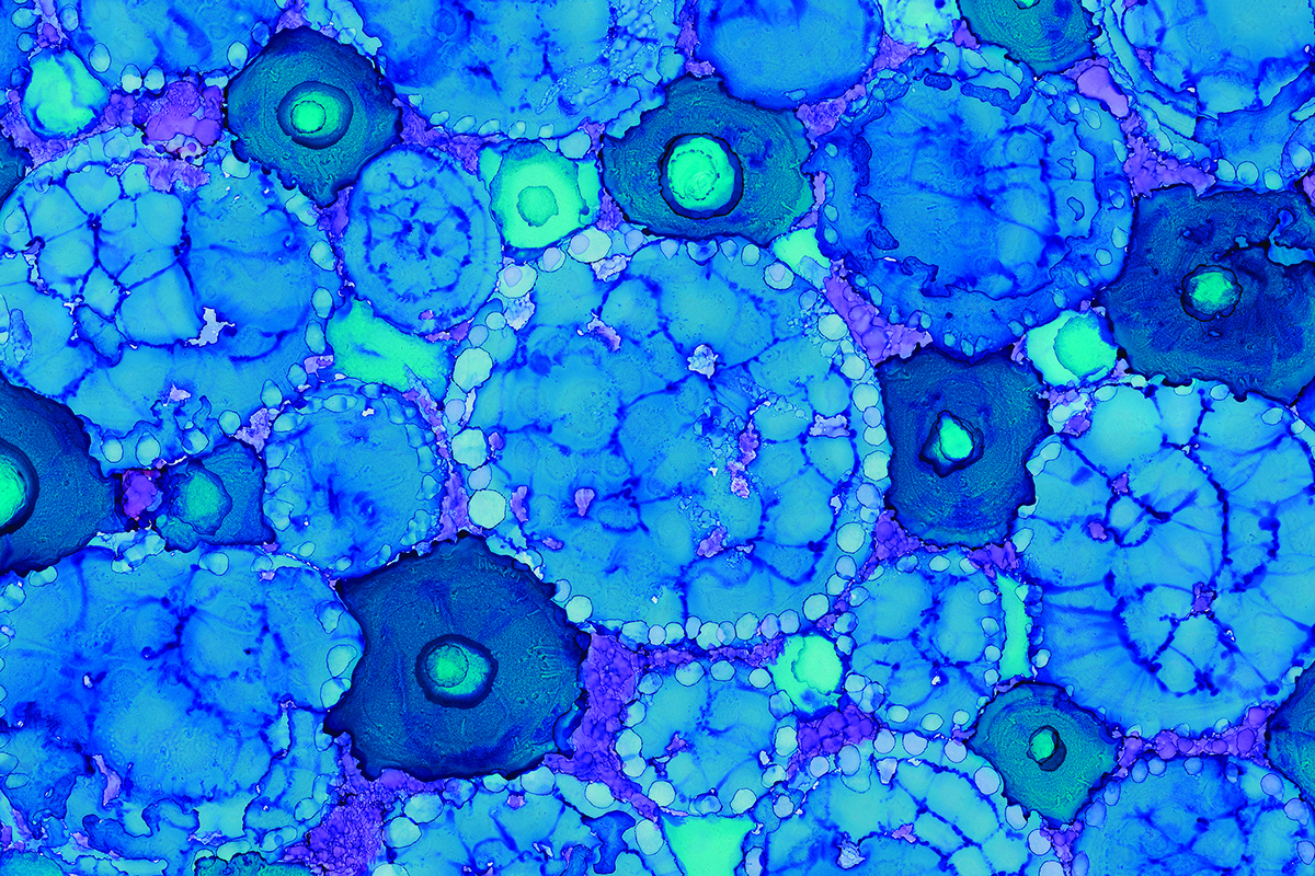 歷年來Vertex的干細胞治療1型糖尿病的研究進展