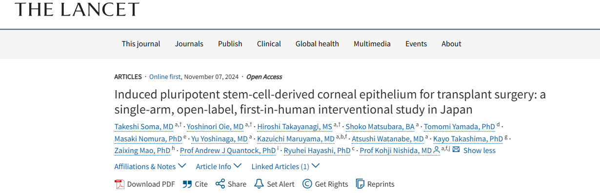 《誘導性多能干細胞來源的角膜上皮用于移植手術:日本的一項單臂、開放標簽、首次人體介入研究》 《誘導性多能干細胞來源的角膜上皮用于移植手術:日本的一項單臂、開放標簽、首次人體介入研究》
