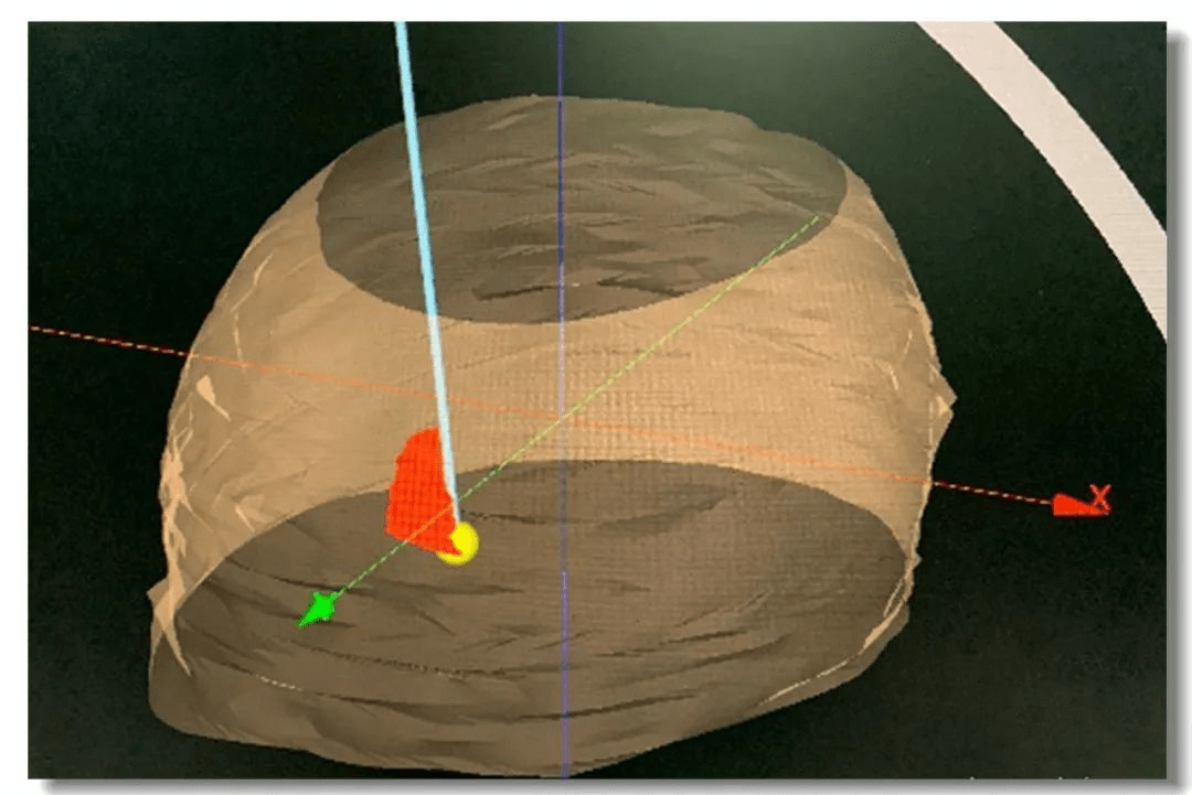 圖1:立體定向手術 圖1:立體定向手術