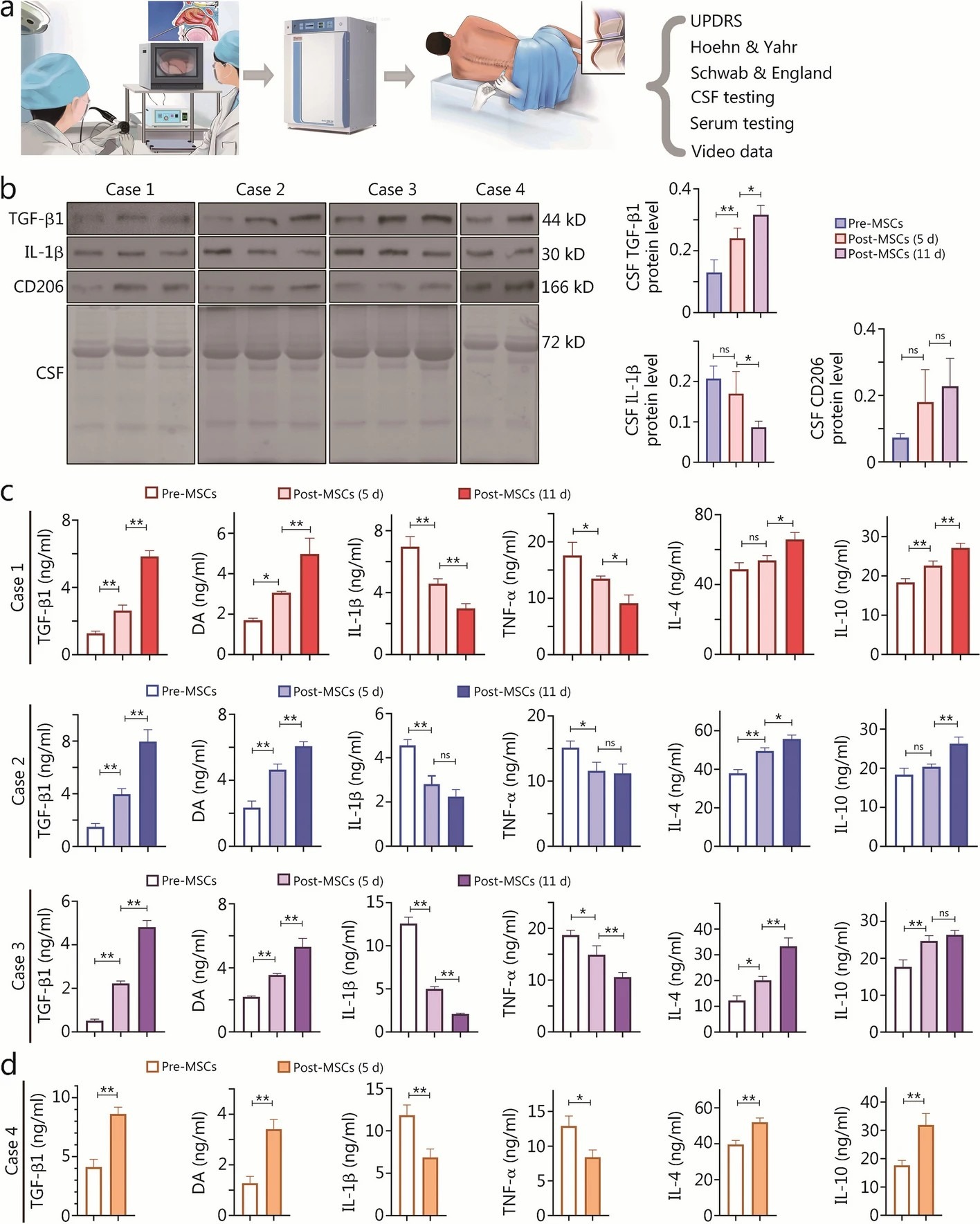 帕金森病患者 I 期 hOM-MSC 植入臨床試驗 帕金森病患者 I 期 hOM-MSC 植入臨床試驗