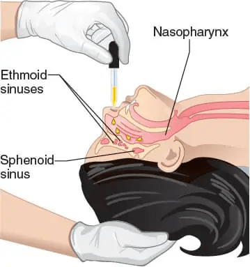 干細(xì)胞輸送方法有13種,其中干細(xì)胞移植的過程都是什么樣的?