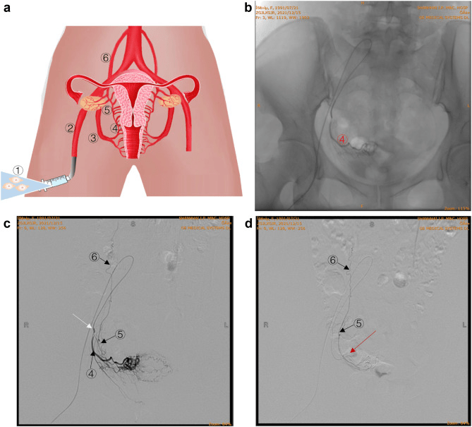 圖1:通過卵巢動脈精確輸注hAEC 圖1:通過卵巢動脈精確輸注hAEC