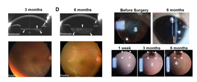 手術(shù)后六個(gè)月，囊袋充滿了再生晶狀體組織