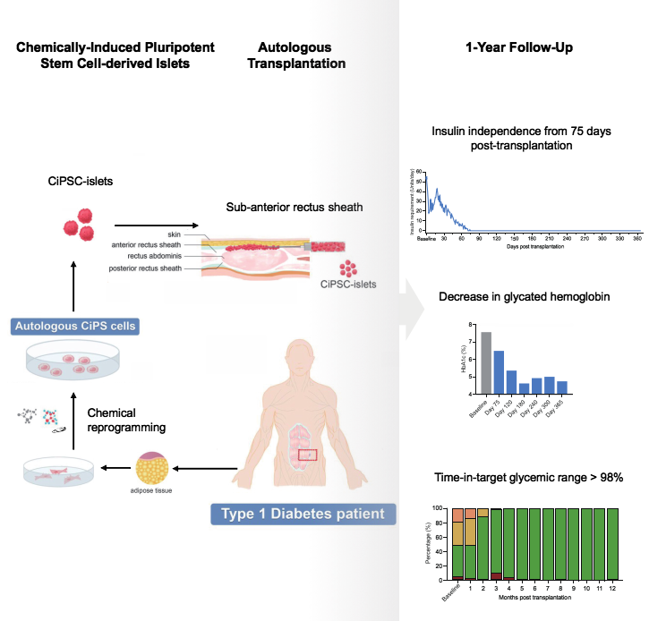 圖2：SLE患者接受CAR-T細(xì)胞治療的程序和結(jié)果。