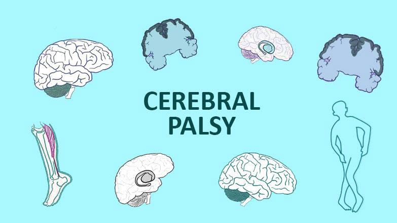 從步履蹣跚到穩(wěn)健行走：干細胞技術(shù)如何重塑腦癱兒童平衡能力？