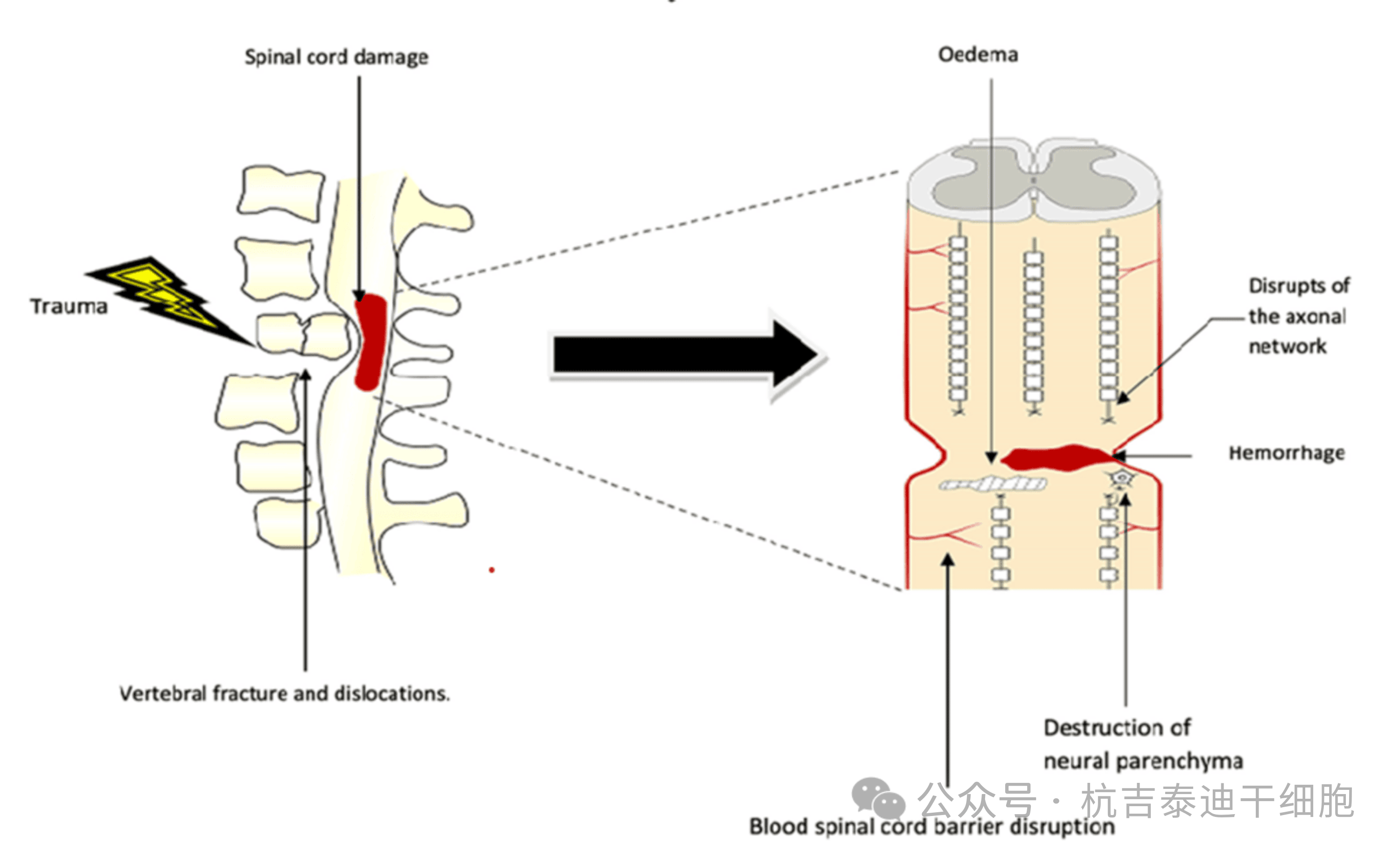 圖1：原發性病變，該圖顯示了創傷的直接影響，包括椎骨骨折、脫位和脊髓損傷導致軸突斷裂、水腫、出血和神經實質破壞