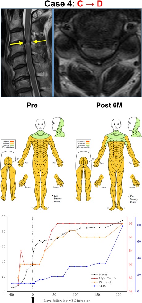 干細胞治療后患者的恢復狀態圖