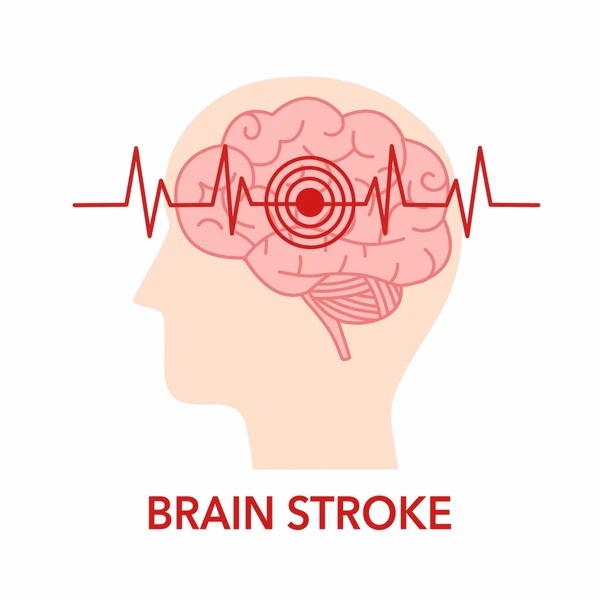 直擊腦卒中:神經(jīng)干細胞移植的治療方法有哪些? 直擊腦卒中:神經(jīng)干細胞移植的治療方法有哪些?