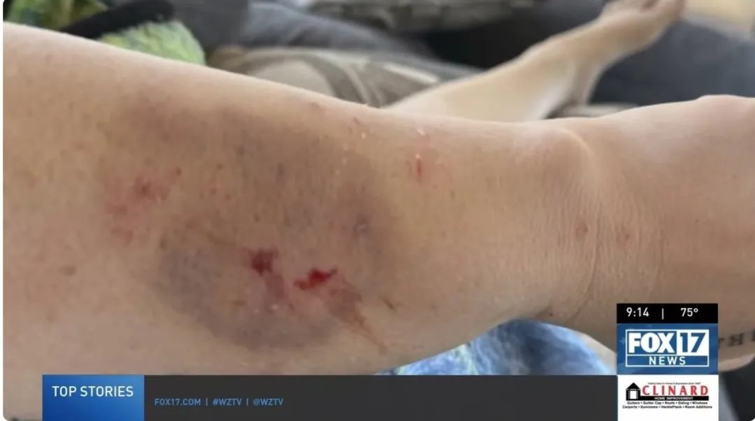 在接受干細胞治療前表現出嚴重的自閉癥癥狀，甚至曾咬傷母親安吉拉，留下了永久的疤痕