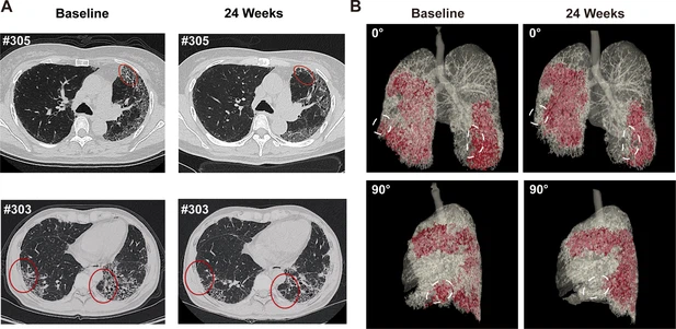 圖4：REGEND001治療前后的代表性肺部CT圖像。