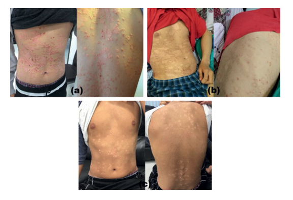 G-MSC 輸注對患有 5 年嚴(yán)重斑塊性銀屑病的 19 歲男性的影響。