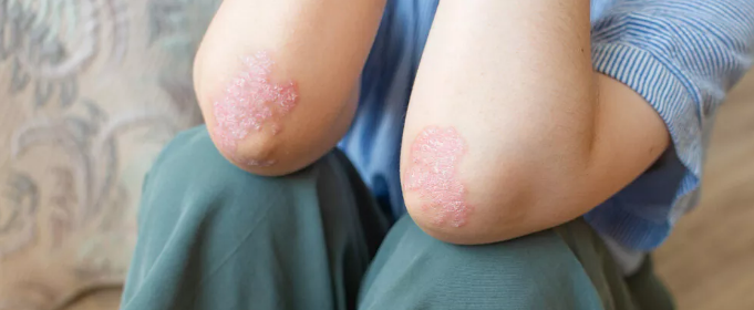 干細(xì)胞治療銀屑病：如何實(shí)現(xiàn)從短期銀屑病面積減少到長期皮膚恢復(fù)正常？