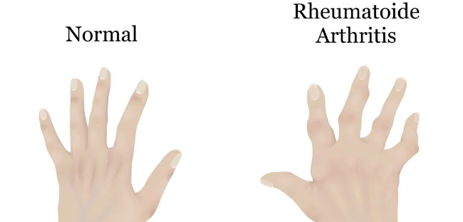 干細胞治療類風濕關節(jié)炎：如何實現(xiàn)從短期關節(jié)功能改善到長期的生活質(zhì)量提升？