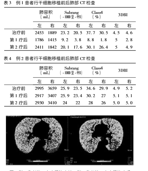 干細胞移植前后的肺部CT檢查對比