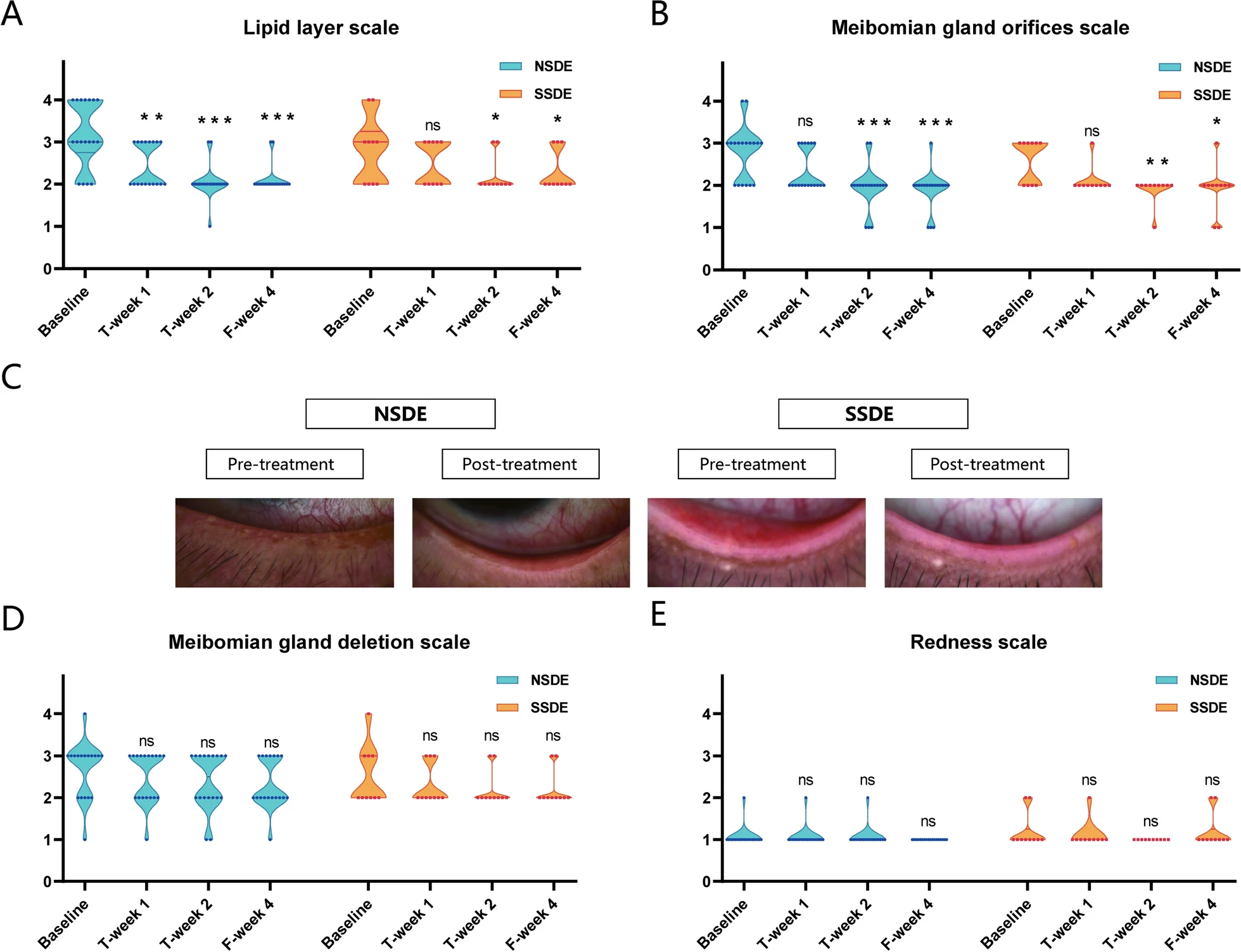 圖3:NSDE和SSDE組基線、T第1周、T第2周和F第4周的脂質層、瞼板腺和紅斑量表。 圖3:NSDE和SSDE組基線、T第1周、T第2周和F第4周的脂質層、瞼板腺和紅斑量表。