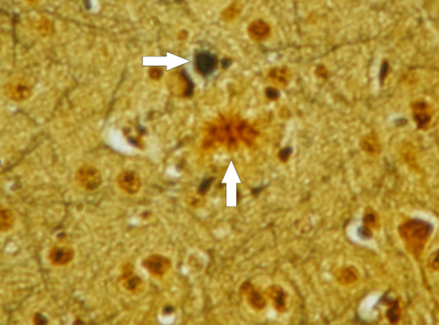 圖4：本圖描繪了三重轉(zhuǎn)基因小鼠模型中阿爾茨海默病的病理特征。