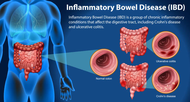 干細胞終結炎癥性腸病?8大問題解答揭秘細胞療法如何改寫治療規則 干細胞終結炎癥性腸病?8大問題解答揭秘細胞療法如何改寫治療規則