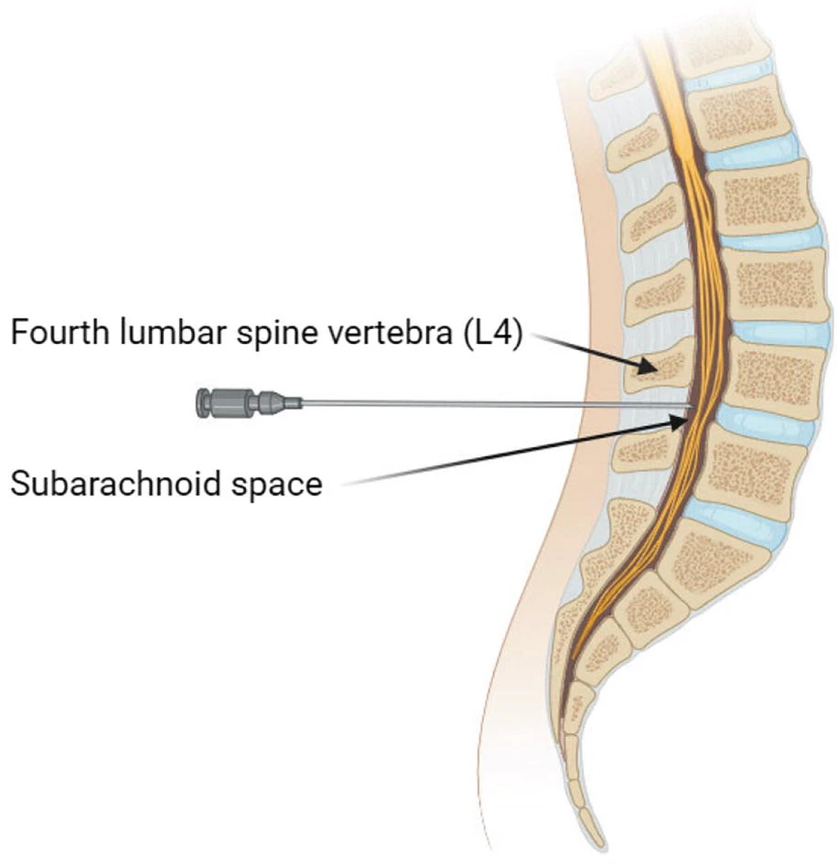 鞘內(nèi)細胞輸注