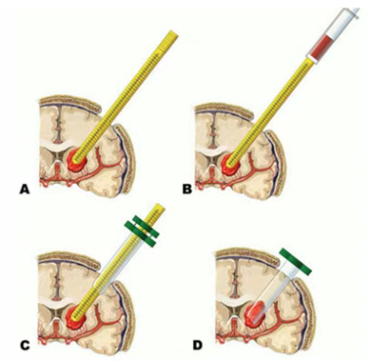 神經(jīng)內(nèi)鏡輔助下腦內(nèi)血腫清除術(shù)示意圖 神經(jīng)內(nèi)鏡輔助下腦內(nèi)血腫清除術(shù)示意圖