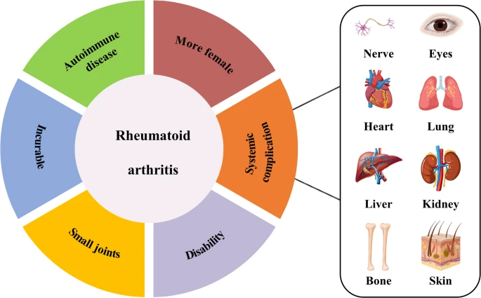 圖1:類風(fēng)濕性關(guān)節(jié)炎的一般特征。 圖1:類風(fēng)濕性關(guān)節(jié)炎的一般特征。