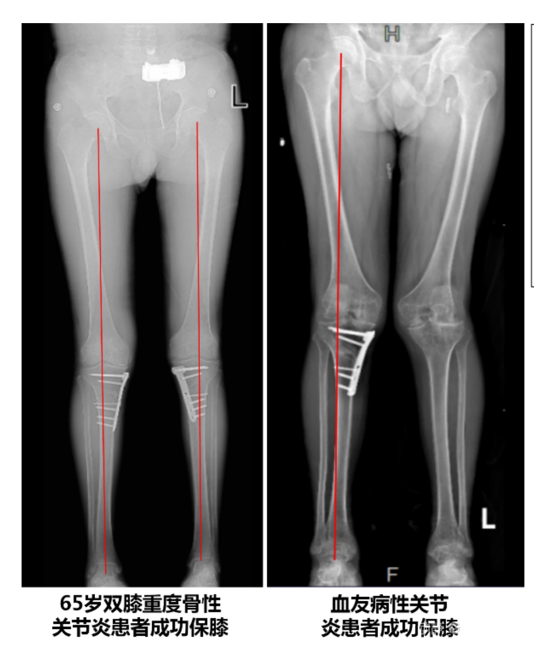 APTT-HTO脛骨高位截骨術(shù)