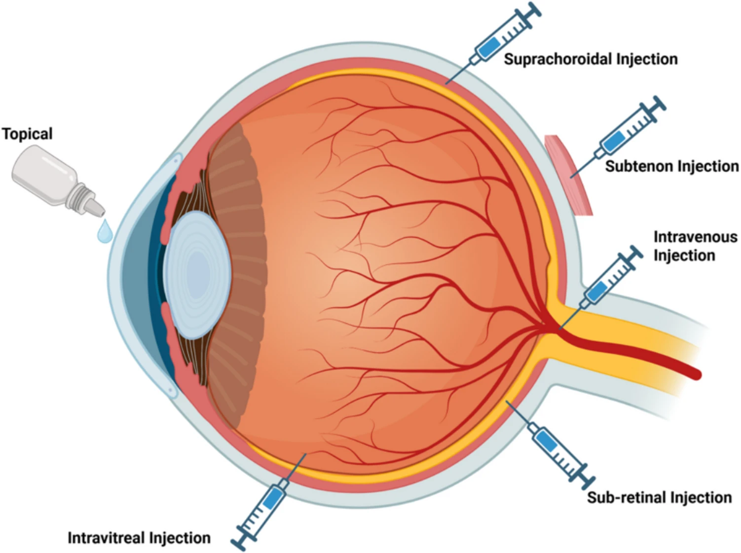 圖2:眼部基因和干細胞治療的給藥途徑 圖2:眼部基因和干細胞治療的給藥途徑