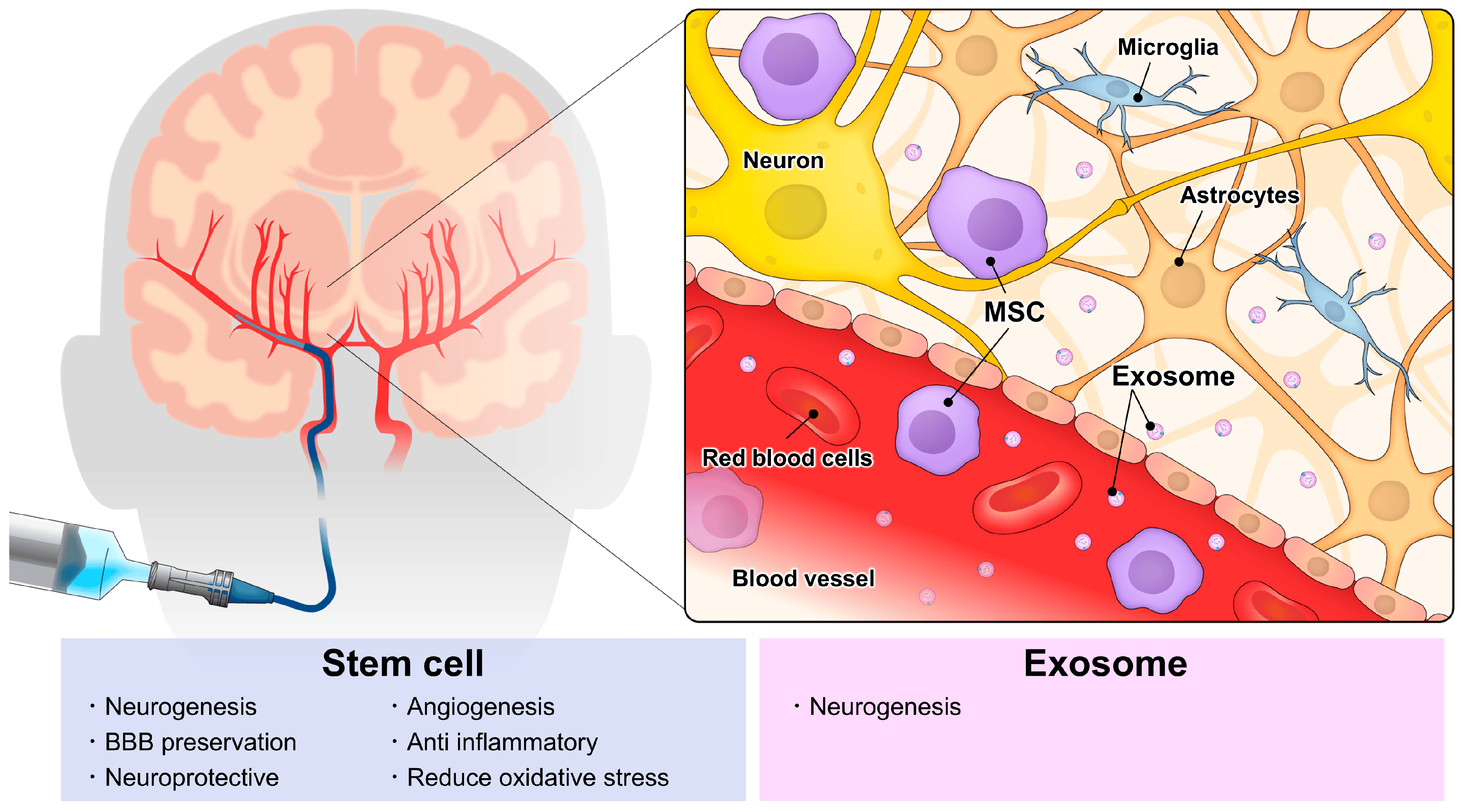 動脈注射干細胞&外泌體治療神經系統疾病,打多少細胞合適?什么時候移植好? 動脈注射干細胞&外泌體治療神經系統疾病,打多少細胞好?