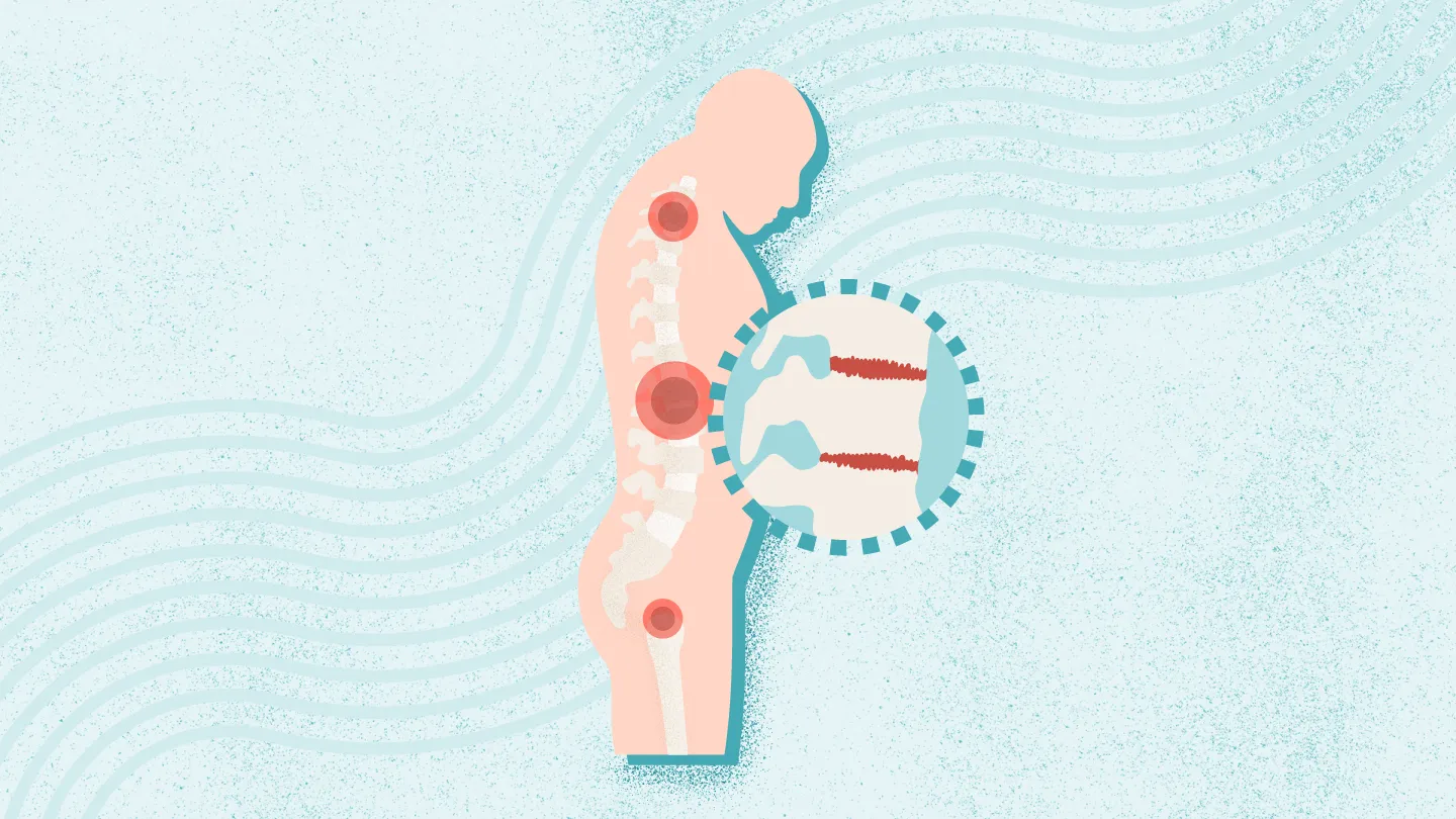 2025年干細胞治療強直性脊柱炎最新臨床進展(截至12月) 2025年干細胞治療強直性脊柱炎最新臨床進展(截至12月)