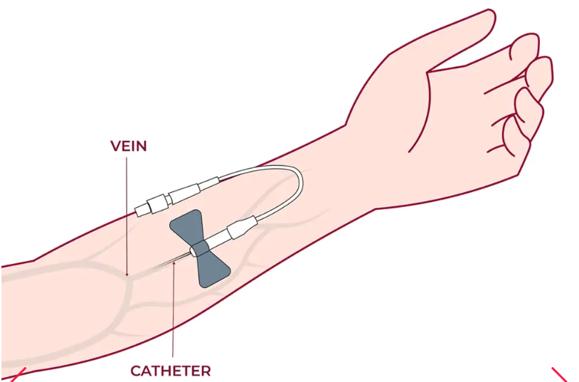 細胞通過靜脈輸注進行給藥,在某些情況下,可以使用其他輸送方法(例如鼻噴霧劑或局部應用)來針對特定系統。 細胞通過靜脈輸注進行給藥,在某些情況下,可以使用其他輸送方法(例如鼻噴霧劑或局部應用)來針對特定系統。