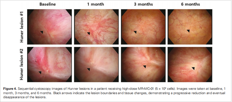 間質(zhì)性膀胱炎臨床試驗(yàn)