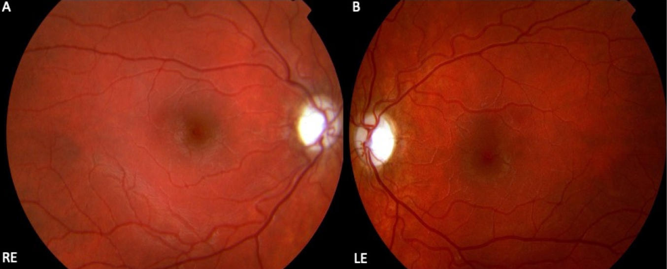 遺傳性視神經病變 遺傳性視神經病變