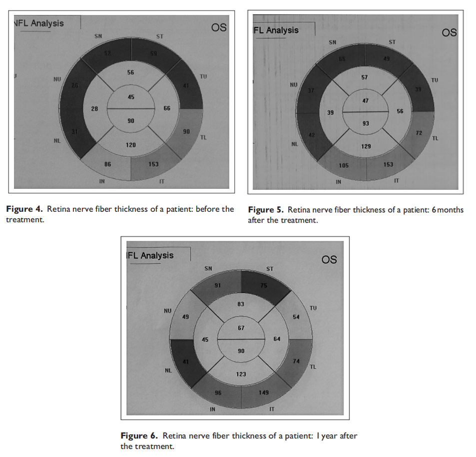 視神經(jīng)萎縮臨床試驗(yàn) 視神經(jīng)萎縮臨床試驗(yàn)
