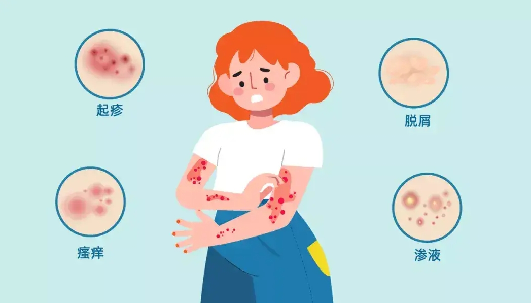 特應性皮炎 特應性皮炎