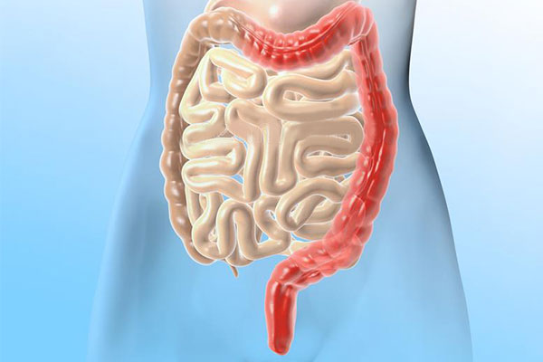 潰瘍性結腸炎新希望：干細胞移植2個月緩解率達7成，4成患者實現粘膜愈合