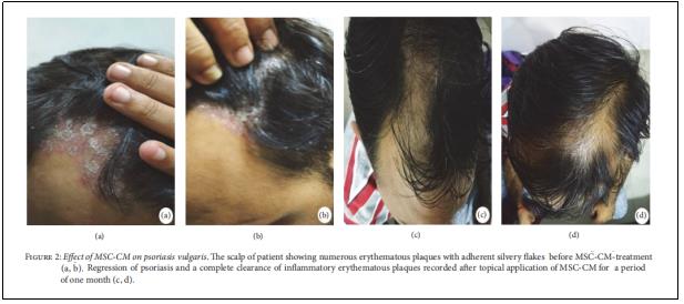 圖2:MSC-CM對(duì)尋常型銀屑病的影響。 圖2:MSC-CM對(duì)尋常型銀屑病的影響。