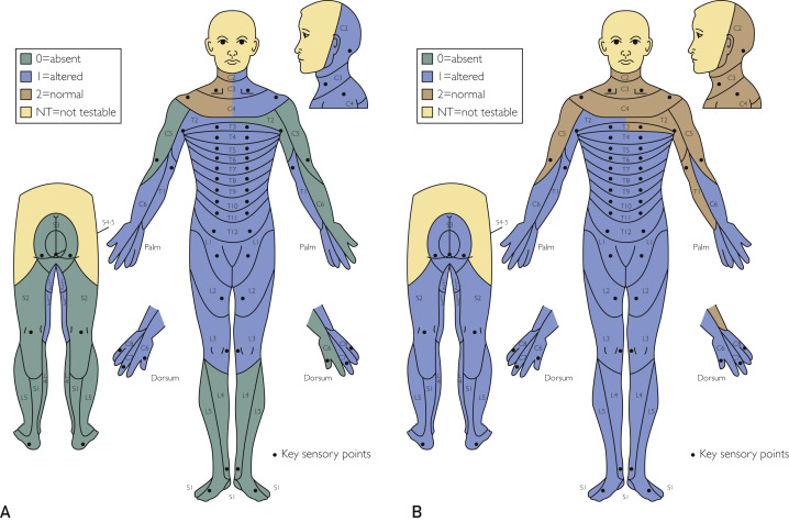 圖2:根據脊髓損傷神經學分類國際標準,在基線(A)和 18 個月隨訪(B)時形成的皮節感覺評分。 圖2:根據脊髓損傷神經學分類國際標準,在基線(A)和 18 個月隨訪(B)時形成的皮節感覺評分。