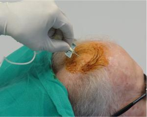 干細(xì)胞注射到大腦過程。 干細(xì)胞注射到大腦過程。