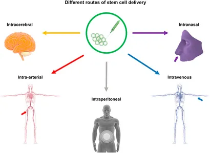 干細胞移植途徑：該圖展示了用于中風治療的干細胞輸送途徑，包括腦內（立體定向注射）、血管內（靜脈/動脈）、腹腔內、腦室內、靜脈內、鼻內和鞘內注射方法。